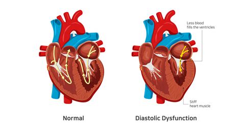 causes of lv diastolic dysfunction|left ventricular diastolic dysfunction symptoms.